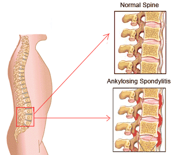 253 best images about ankylosing spondylitis much more on sinus infection home dr rl khullar best homeopathy doctor ankylosing spondylitis hormones types of ankylosing 253 best images about ankylosing spondylitis much more on sinus infection home dr rl khullar best homeopathy doctor ankylosing spondylitis hormones types of ankylosing